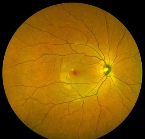 为什么会出现视网膜变性，有什么治疗方法吗？